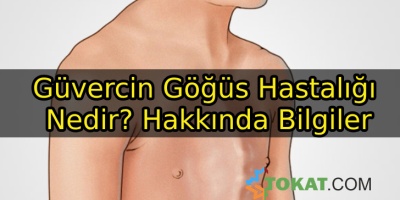Güvercin Göğüs Hastalığı Nedir? Hakkında Bilgiler